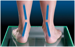 Flat Feet Overpronation : Causes and Solutions