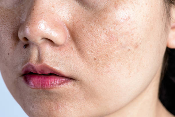 The Importance of Patch Testing: Preventing Allergic Reactions from Pigmentation Treatment