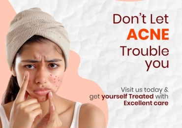 facial port wine stain Treatment in india