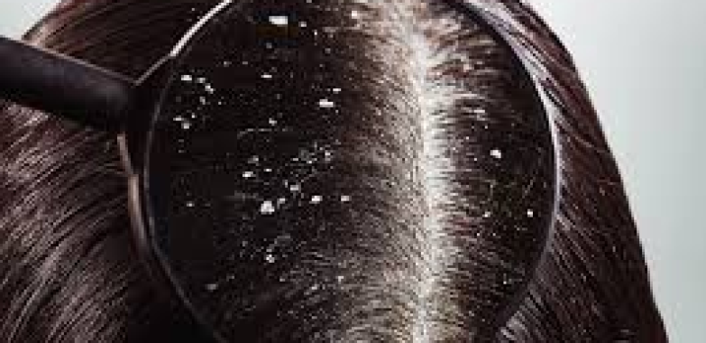 Why You Shouldn’t Scratch Your Scalp When You Have Dandruff