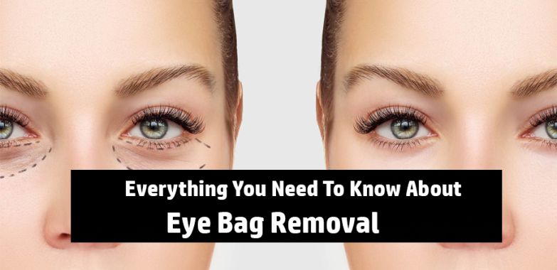 Everything You Need To Know About Eye Bag Removal