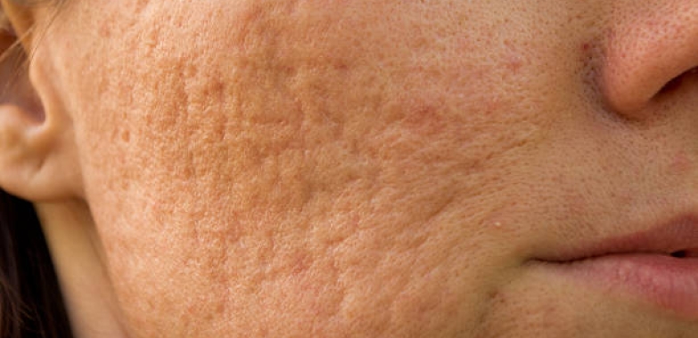 Frequently Asked Questions about Derma Roller Treatment for Acne Scars