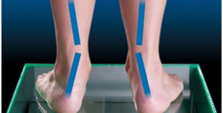 Flat Feet Overpronation : Causes and Solutions