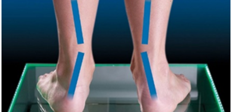Flat Feet Overpronation : Causes and Solutions