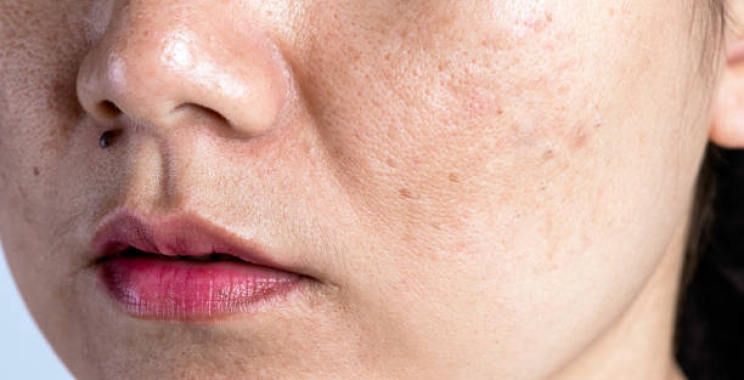 The Importance of Patch Testing: Preventing Allergic Reactions from Pigmentation Treatment