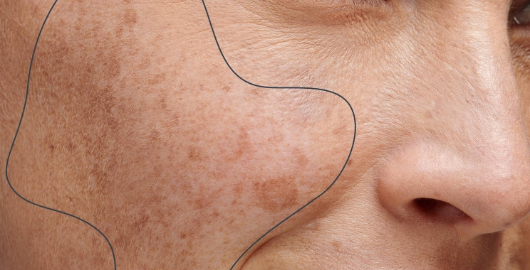 The Top 5 Side Effects of Pigmentation Treatment and How to Avoid Them with the Help of a Skin Specialist